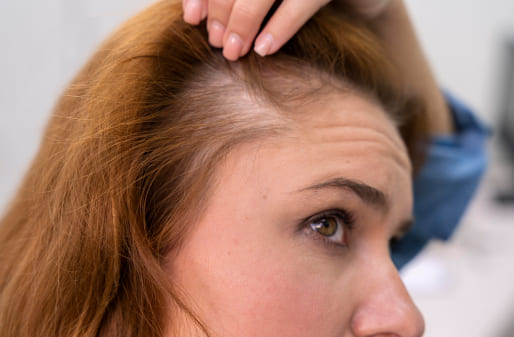 Imagen sobre el servicio de Protesis capilar