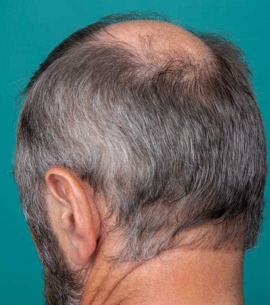 Imagen sobre el servicio de Protesis capilar en Terrassa